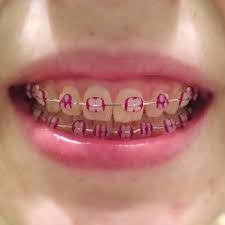 Black And Purple Braces Color 10 Good Things To Choose Purple Braces Braces Colors Dental Braces Teeth Braces