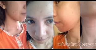 CERITA WANITA: Skincare Story: A Newbie with LBC Part 1