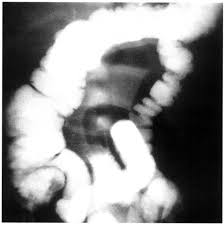 Maybe you would like to learn more about one of these? Ileoileal Intussusception A Report Of Four Cases Annals Of Saudi Medicine