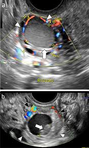 Image result for corpus luteum sonography)