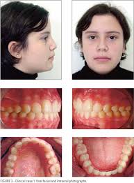 Teeth that have not erupted yet, like unerupted wisdom teeth or teeth broken. Scielo Brasil Extracoes Dentarias Em Ortodontia Avaliacao De Elementos De Diagnostico Extracoes Dentarias Em Ortodontia Avaliacao De Elementos De Diagnostico