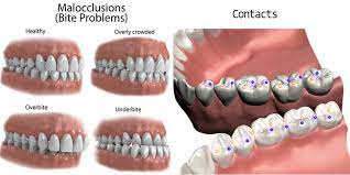 Balancing side (no contacts) scheme of occlusion: Occlusion Dr Gais Dental Center Aesthetic Dentistry And Implantology