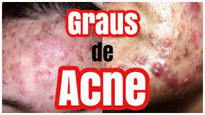 Cravos, espinhas pequenas e grandes. 5 Graus De Acne Quais Sao E Como Identificar Youtube