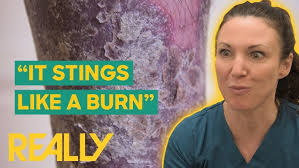 Dr. Emma Helps Patient With Back Sores That Have Destroyed His Confidence l  The Bad Skin Clinic