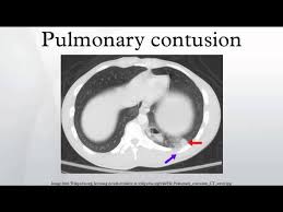 Image result for Pulmonary Contusion