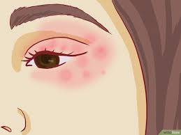 How To Treat Eczema Around The Eyes With Pictures How To Treat Eczema Eczema Treatment Eczema Remedies