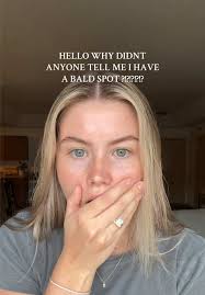 Identifying and Managing Bald Spots in Hair