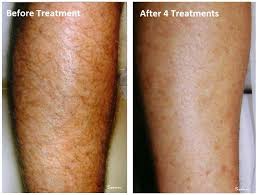 However, it's important to note that this service doesn't always result in permanent hair make sure the doctor doing your laser hair removal is board certified, and check reviews online to see how many patients have provided feedback. Laser Hair Removal Permanent Hair Removal Aesthetic Laser Services Jefferson City Missouri