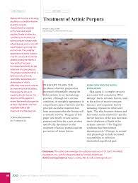 Purpura simplex is increased bruising that results from vascular fragility. Pdf Treatment Of Actinic Purpura