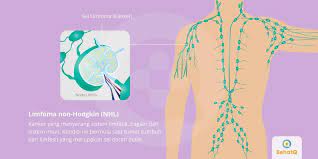 Prevention & 5 natural ways to manage lymphoma symptoms. Limfoma Non Hodgkin Tanda Dan Gejala Penyebab Cara Mengobati Cara Mencegah