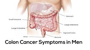 New onset of bright red blood in the stool always deserves an evaluation. Colon Cancer Symptoms In Men Youtube