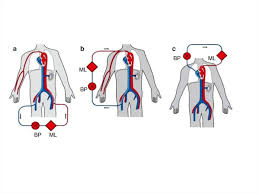 American thoracic society patient education | information series www.thoracic.org clip and copy the ecmo machine replaces the function of the heart and lungs. Fiziologicheskij Ocherk Ekmo Prezentaciya Onlajn