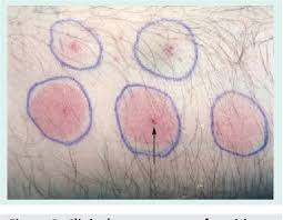 Image result for Pathergy