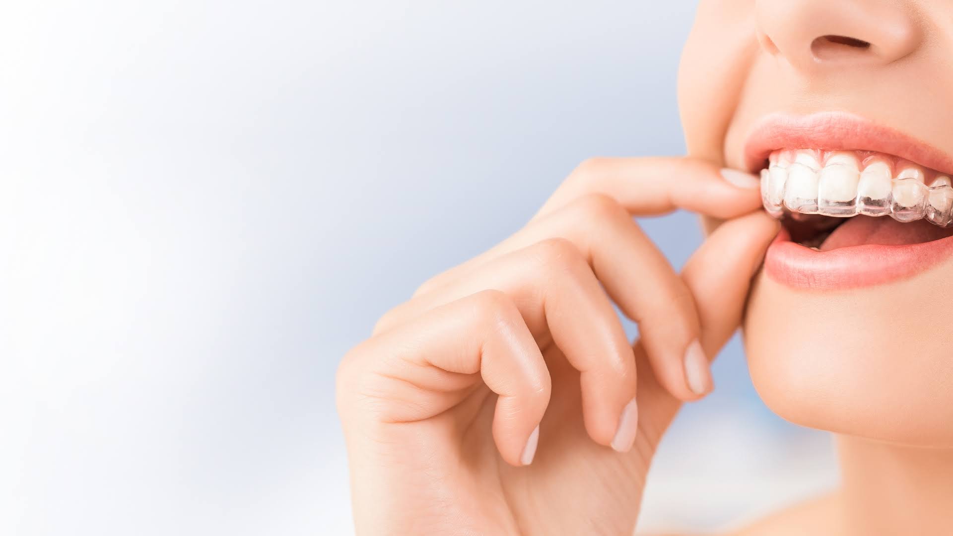 Aligners product image
