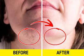 The effects will usually last a few weeks but the procedure is painful. 9 Simple Ingredients To Get Rid Of Facial Hair At Home