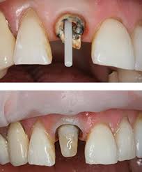 Jul 18, 2021 · the problem is dental implants are more expensive than getting a bridge or dentures. Three Reasons Your Dentist Recommends A Post And Core Even If Insurance Doesn T Cover It Dentistry By Brooksher