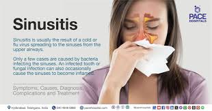 Image result for Sinusitis Prediction Rule