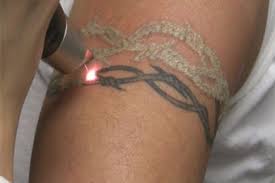Does getting a tattoo removed hurt? India Delhi South Ex New Delhi Gurgaon Noida About Us Contact Us The National Skin Centre H 30 South Extension Part I New Delhi 91 11 24691236 91 11 24634909 91 11 46046346 91 9811300536 91 9811300539 91 9811300550
