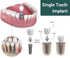 Single Tooth Implant in NJ - Riverside Oral Surgery