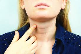 Medullary thyroid cancer may cause a lump to form in the neck. Anaplastic Thyroid Cancer Faqs What You Need To Know Dr Seeds