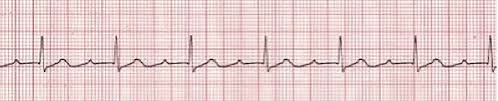 Acls Symptomatic Bradycardia