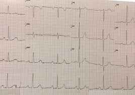 Maybe you would like to learn more about one of these? Ecg Quiz Resus