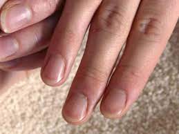 Was Bedeuten Weisse Flecken Auf Den Fingernageln Gesundheit