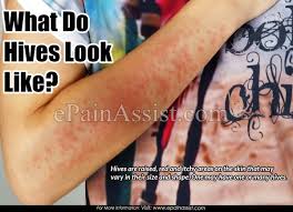 How long do hives last? What Do Hives Look Like How Long Does It Take For Hives To Fully Go Away