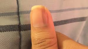 6 things that show the relationship between your nails and health these pictures of this page are about:horizontal line on nail bed. Black Lines On Nails During Pregnancy Nailstip
