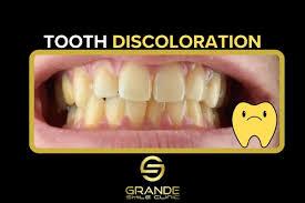 Image result for Tooth Discoloration