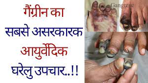 © 2019 copyright all rights reserved. à¤— à¤— à¤° à¤¨ à¤• à¤¸à¤¬à¤¸ à¤…à¤¸à¤°à¤• à¤°à¤• à¤†à¤¯ à¤° à¤µ à¤¦ à¤• à¤˜à¤° à¤² à¤‰à¤ªà¤š à¤° Gangrene Treatment In Hindi Diabetic Foot Ulcer Youtube
