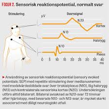 Plötsligt hjärtstopp kan drabba vem som helst. Bedomning Av Neurologisk Prognos Efter Hjartstopp