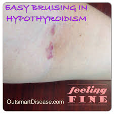 Why Easy Bruising Is So Common In Hypothyroidism Many Hypothyroid And Hashimoto S Patients Have It But Don T Thyroid Healing Thyroid Treatment Hypothyroidism