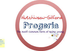 Hutchinson Gilford Progeria By Julianna Rankin On Prezi