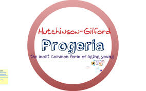 hutchinson gilford progeria by julianna rankin on prezi