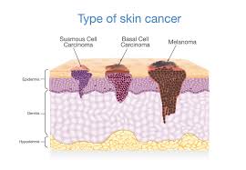 If the melanoma is thicker, your doctor may recommend additional tests to see if the cancer has spread before determining your treatment options. Skin Cancer Dermatology Centers Of Wv