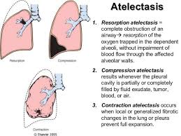 Image result for Atelectasis