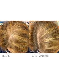 Research shows that those with alopecia, hair breakage, and reduced hair growth often suffer from insufficient lysine. Nutrafol Hair Growth Supplements Rejuvent Skincare