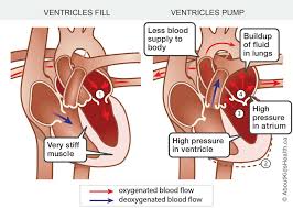 Image result for Restrictive Cardiomyopathy