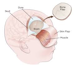 Brain Tumour Surgery Treatment Symptoms Recovery Brain Tumor Brain Surgery Cancer Care Hospital