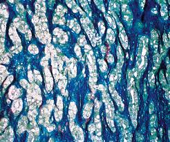Few cancers have so captivated the . Malignant And Borderline Mesothelial Tumors Of The Pleura Clinical Gate