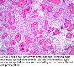 All indices were significantly elevated not only in undescended but in contralateral scrotal testes of the cryptorchid patients in comparison to those in normal controls. Pathology Outlines Sertoli Leydig Cell Tumor