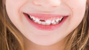 The Do S And Don Ts Of Losing Baby Teeth Babyteeth Baby Teeth Losingteeth Tips Baby Teeth Perfect Teeth Losing Teeth