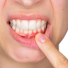 If you're asking for the real natural remedies for receding gums, you have to take the best natural remedy for receding gums is to eliminate as many of the causes as possible. Gum Recession Treatment In Dubai Abu Dhabi Gum Recession Cost