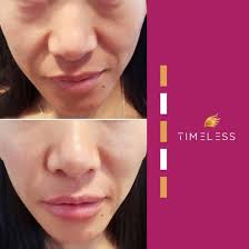 Natural Botox at home with only 2 ingredients Skin like a 30 year old, even  at 65 only polite members will say thank you for the recipe 😊 The recipe  in first comment 😊