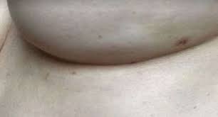Learn the signs and symptoms of breast cancer and talk to your doctor immediately if you experience any of these a breast that's warm, swollen, and red. Common Signs Of Breast Cancer Dimpling Breasts And Breast Cancer