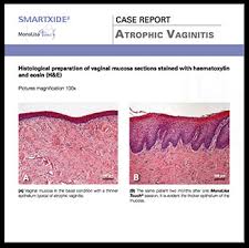 Image result for Atrophic Vaginitis