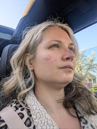 Please house help me my face is always red cause by cream what kind of  cream will I use to make it clear