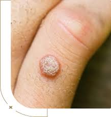 Image result for genital warts