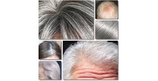 White hair is also common in alopecia areata, an autoimmune skin condition that causes hair loss on the scalp, face and other parts of the body. White Hair Which Are The Causes And How To Fight Them Your Instant Hair Makeup Hair Fiber Kmax